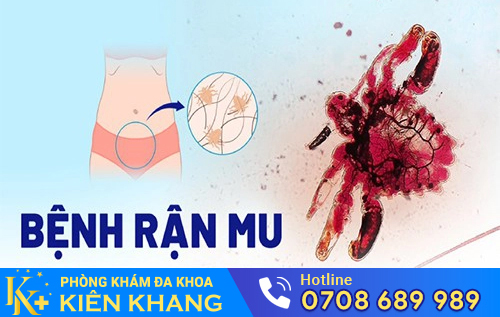 Biểu hiện của bệnh rận mu