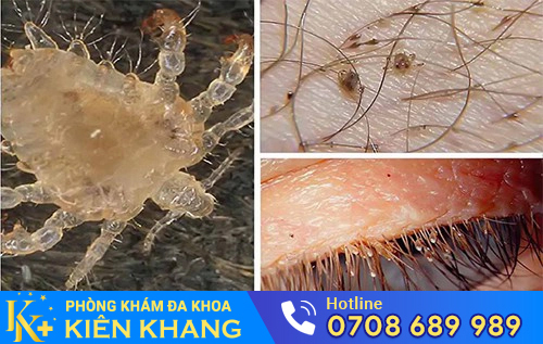 Rận mu có tốc độ sinh sản rất nhanh