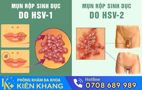 Mụn rộp sinh dục lây nhiễm chủ yếu qua đường quan hệ tình dục không an toàn