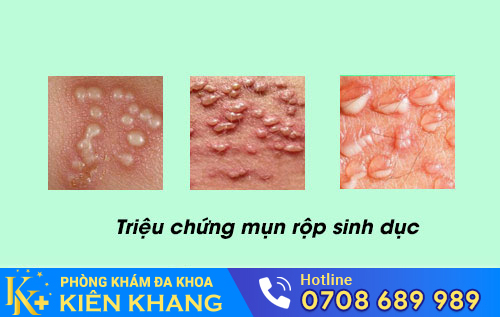 Mụn rộp sinh dục