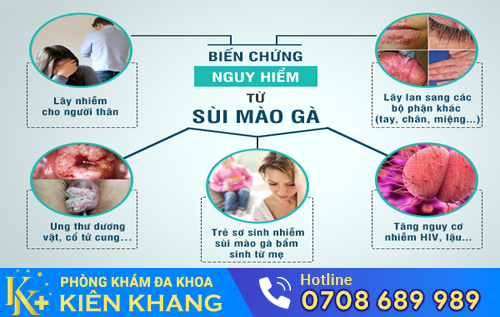 Tự điều trị sùi mào gà tại nhà có hiệu quả?