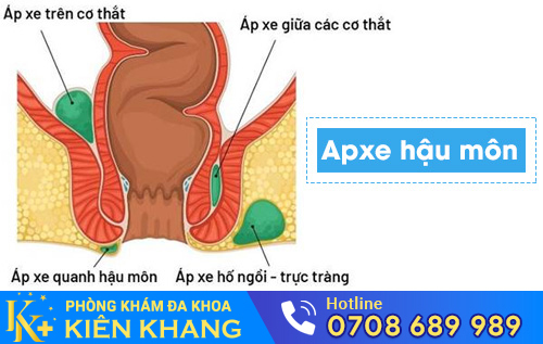 Apxe hậu môn