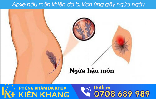 Apxe hậu môn
