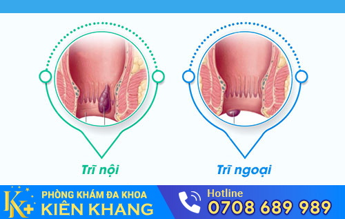 bệnh trĩ