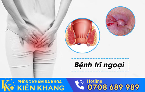 Bệnh trĩ ngoại