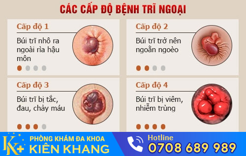 Quá trình phát triển của bệnh trĩ ngoại