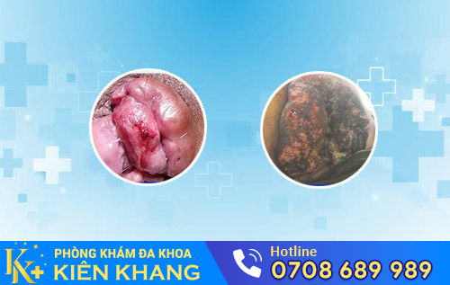 Biến chứng nguy hiểm của bệnh trĩ