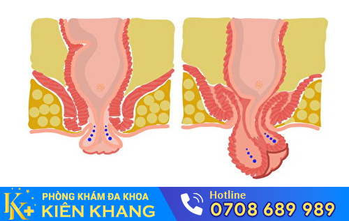 Các búi trĩ sa ra ngoài thì buộc phải cắt