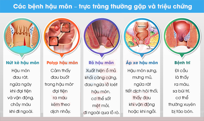 Các bệnh về hậu môn, trực tràng thường gặp
