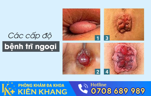 Bệnh trĩ ngoại