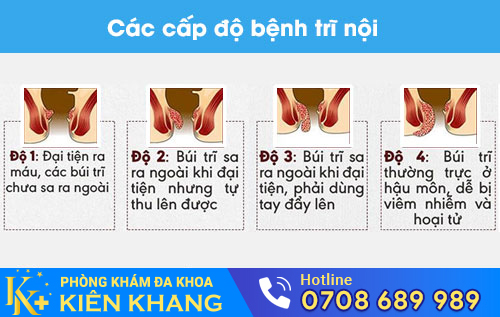 Các cấp độ bệnh trĩ nội