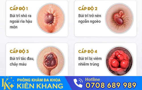 Hình ảnh bệnh trĩ