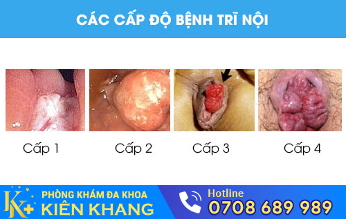 Các cấp độ bệnh trĩ nội