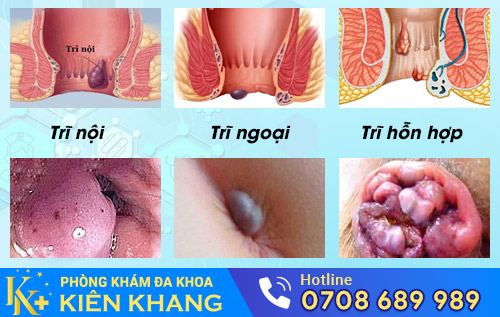 Các loại bệnh trĩ