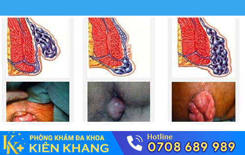 Dấu hiệu nhận biết bệnh lòi dom