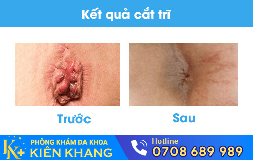 Kết quả cắt trĩ