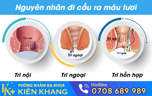 Nguyên nhân đi cầu ra máu tươi