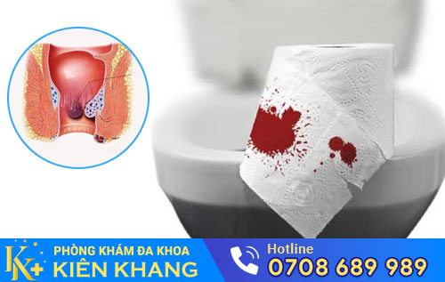 Nguyên nhân đi cầu ra máu