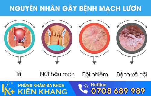 Nguyên nhân gây bệnh mạch lươn