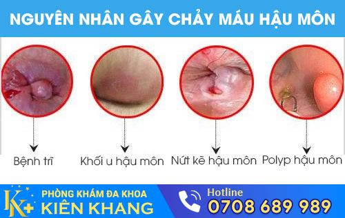 Nguyên nhân gây chảy máu hậu môn