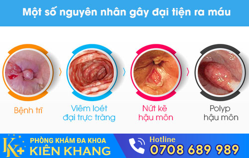 Một số nguyên nhân gây đại tiện ra máu