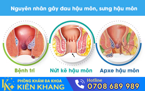 Một số nguyên nhân gây đau hậu môn, sưng hậu môn