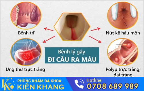 Nguyên nhân đi cầu ra máu