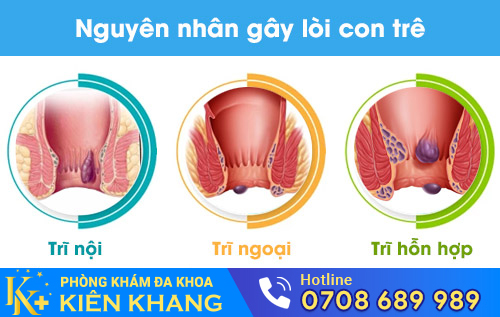 Nguyên nhân gây lòi con trê
