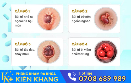 Nguyên nhân gây ngứa hậu môn