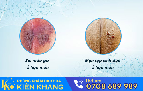 Nổi mụn nhọt ở hậu môn
