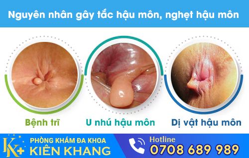 Một số nguyên nhân gây tắc hậu môn, nghẹt hậu môn