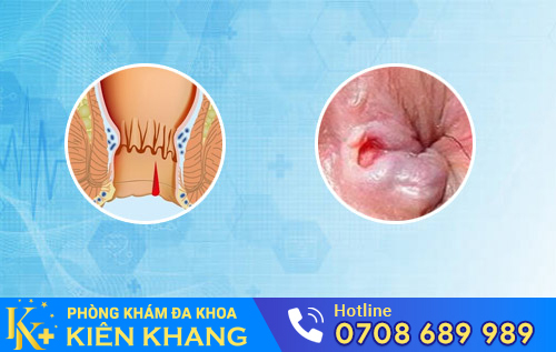 Nứt kẽ hậu môn