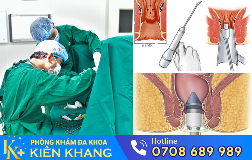 Áp dụng phương páp điều trị bệnh hậu môn hiệu quả