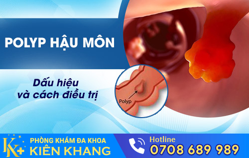 Polyp hậu môn