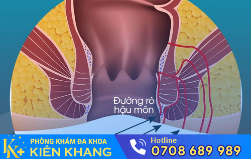 rò hậu môn