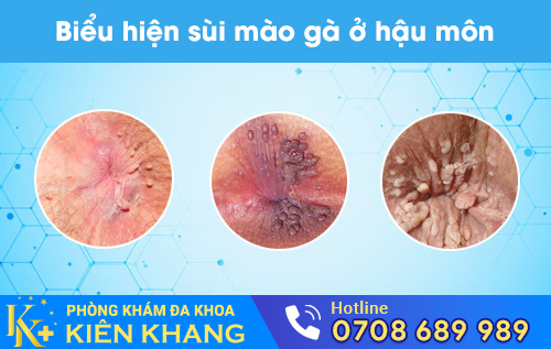 Sùi mào gà ở hậu môn