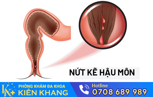 Sưng đau hậu môn có thể là do nứt kẽ hậu môn gây ra