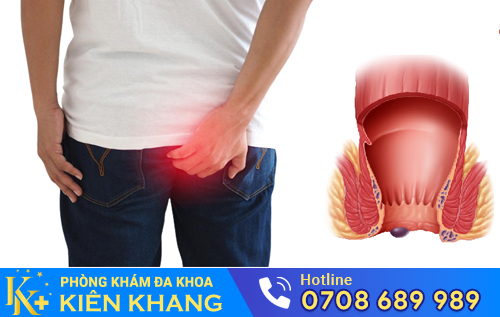 Sưng đau hậu môn có thể là dấu hiệu của nhiều bệnh lý nguy hiểm?