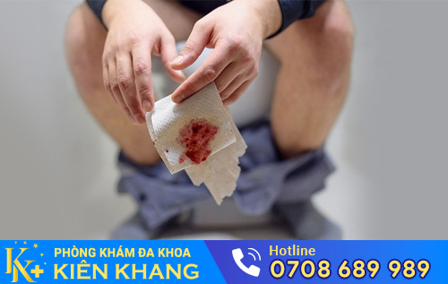 Táo bón là một nguyên nhân gây ra trĩ