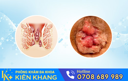 Bệnh trĩ hỗn hợp