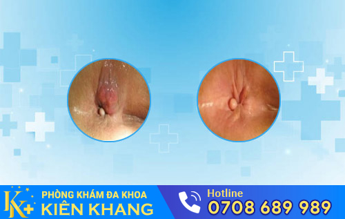 Bệnh trĩ ngoại độ 1