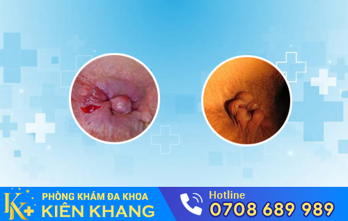 bệnh trĩ ngoại độ 2