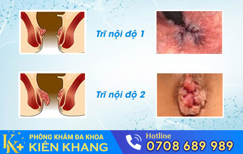 Trĩ nội độ 1, độ 2