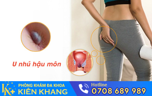 U nhú hậu môn