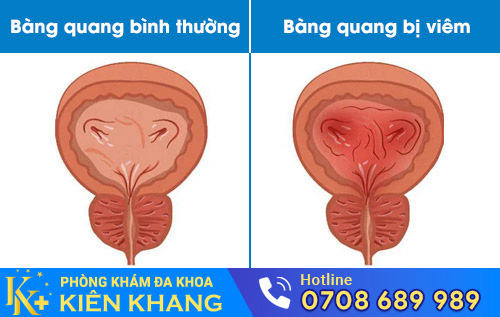 Viêm bàng quang