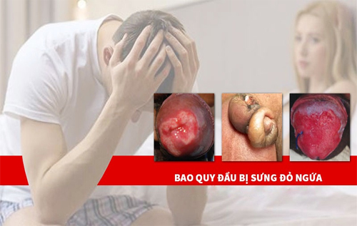 Biểu hiện của bao quy đầu sưng đỏ