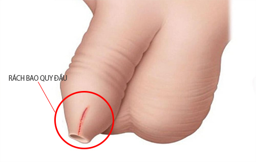 Hình ảnh rách bao quy đầu
