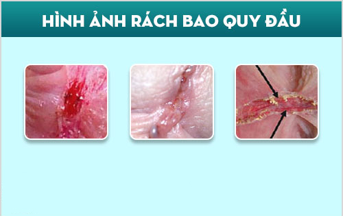 Hình ảnh rách bao quy đầu ở nam giới