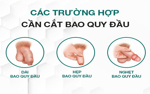 Trường hợp cần cắt bao quy đầu