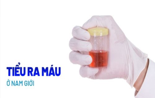 Hình ảnh tiểu ra máu ở nam giới